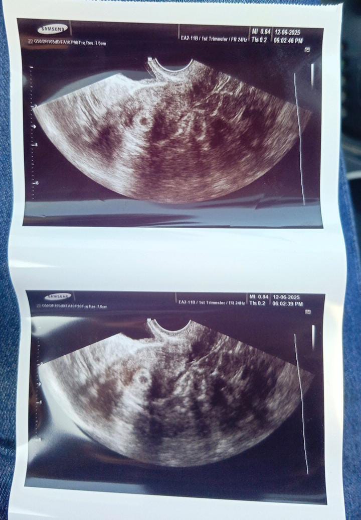 First Ultrasound Picture👶🖼️ 